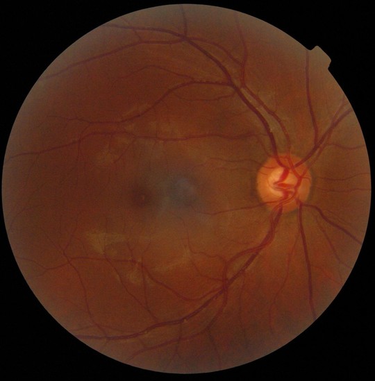 Le point aveugle, centre de convergence du nerf optique, représenté en clair ici